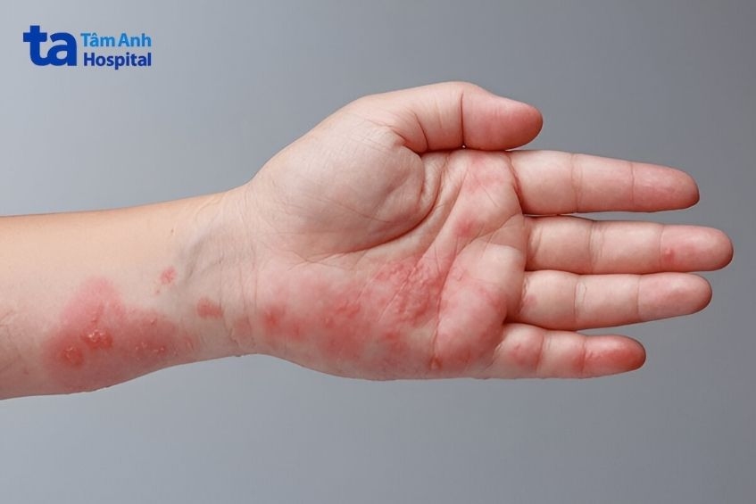 vết thương nhiễm trùng lan rộng do ghẻ phỏng kéo dài
