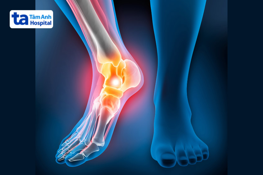 Viêm khớp cổ chân ảnh hưởng tới chất lượng cuộc sống