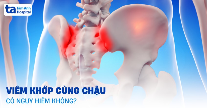 Viêm khớp cùng chậu có nguy hiểm không? Các biến chứng thường gặp