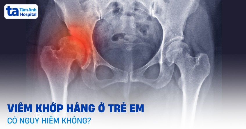 Viêm khớp háng ở trẻ em có nguy hiểm không? Nhóm trẻ em dễ mắc bệnh