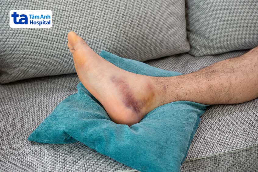 Viêm khớp mắt cá chân gây sưng