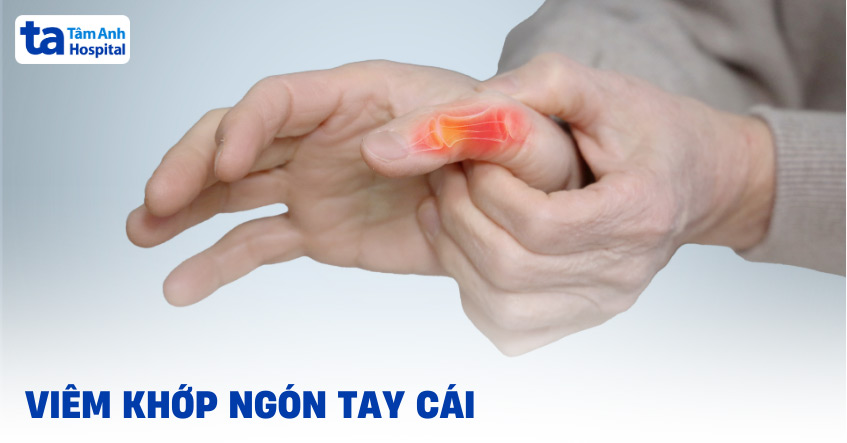 Viêm khớp ngón tay cái
