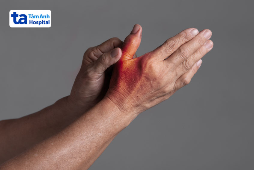 Viêm khớp ngón tay khiến khớp bị sưng