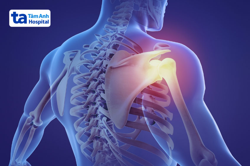 Viêm khớp vai không thể tự khỏi
