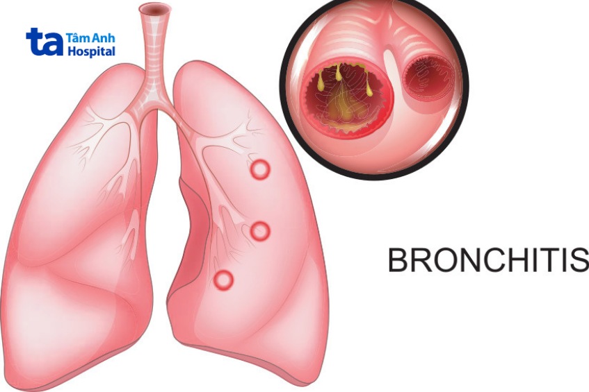 viêm phế quản mãn tính rất nguy điểm đối với sức khỏe