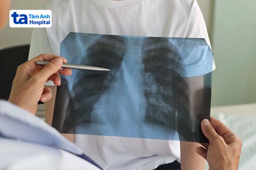 Viêm phổi là biến chứng bệnh bạch hầu