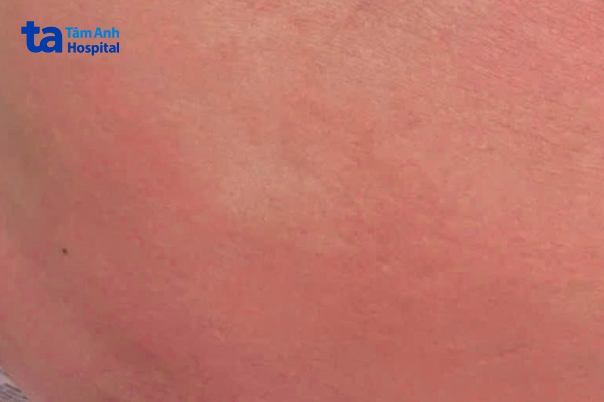 vùng da đỏ rát của người bệnh