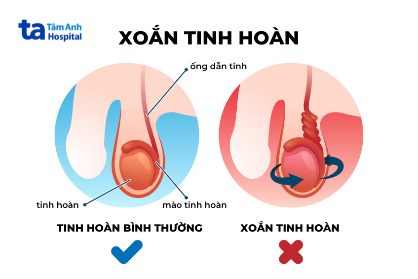 Xoắn tinh hoàn cần cấp cứu sớm để tránh gây hoại tử tinh hoàn hoặc giảm chức năng của tinh hoàn