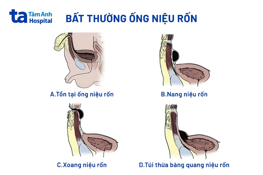 4 loại bất thường ống niệu rốn thường gặp