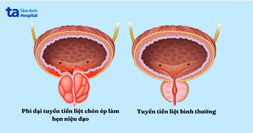 ai dễ bị tiểu lắt nhắt về đêm
