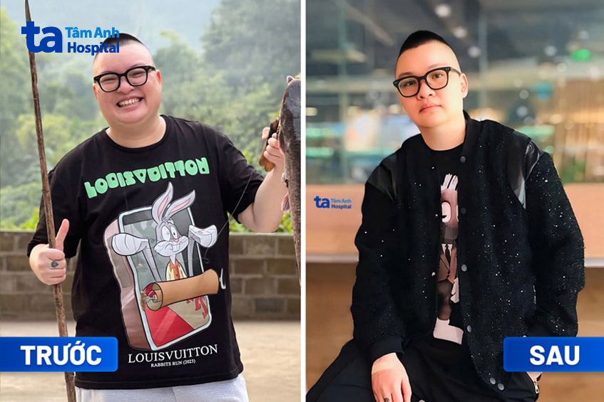 Anh Trần Nhựt Quang trước và sau giảm cân tại BVĐK Tâm Anh