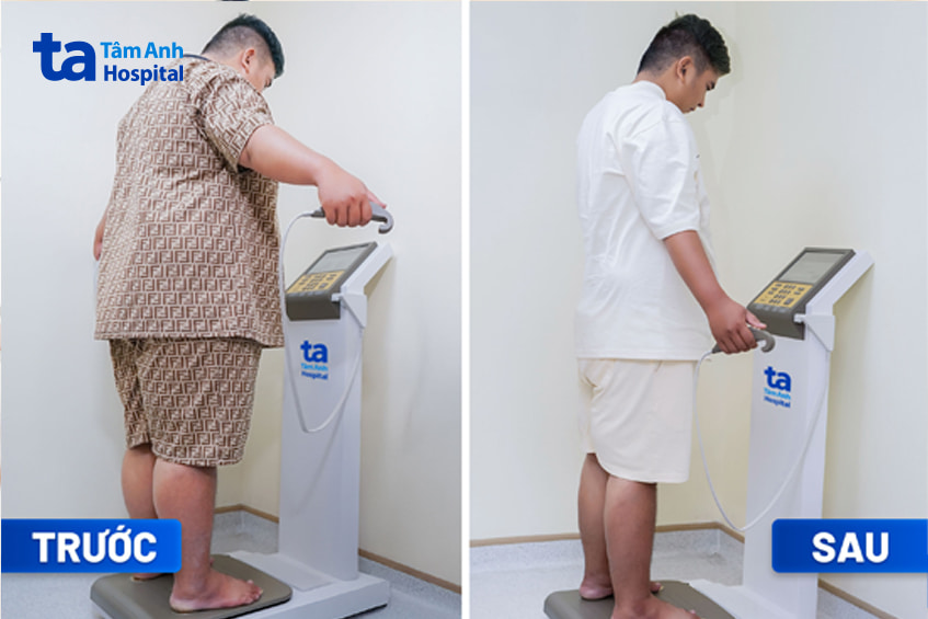 Anh Trần Nhựt Quang trước và sau khi giảm cân tại BVĐK Tâm Anh