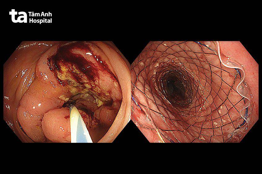 ảnh nội soi trước và sau đặt stent