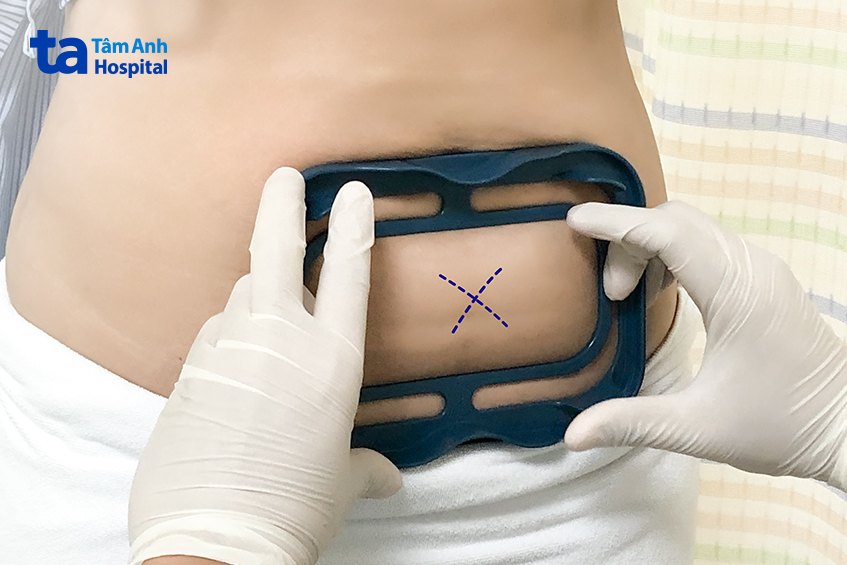 bác sĩ đánh dấu khu vực đông hủy mỡ