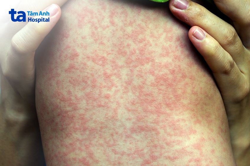 ban sởi lây lan gây tiêu chảy