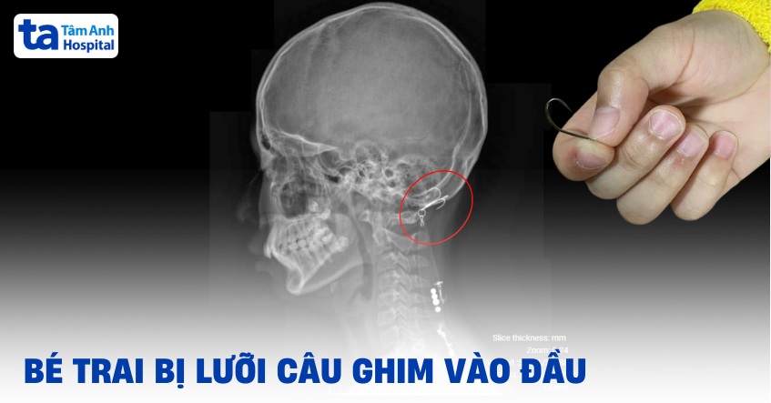 bé trai bị lưỡi câu ghim vào đầu