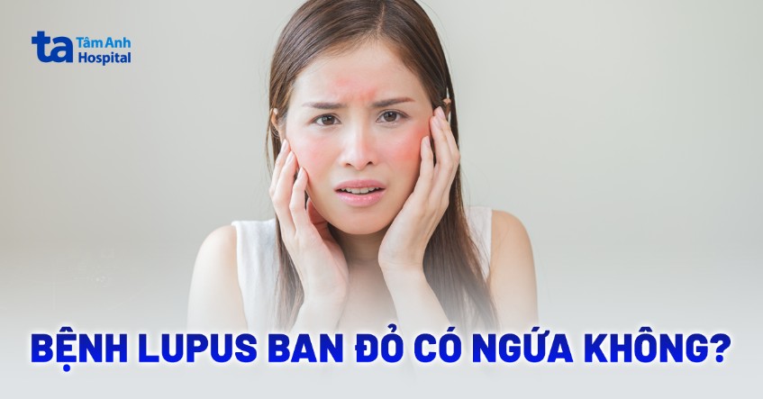 Bệnh lupus ban đỏ có ngứa không? Nguyên nhân, cách giảm và lưu ý