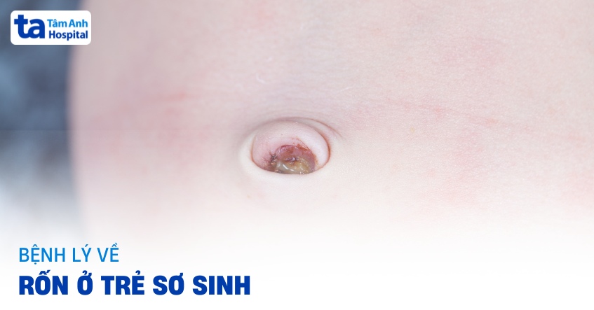 Bệnh lý về rốn ở trẻ sơ sinh thường gặp các mẹ nên biết