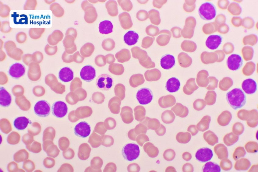 bệnh sản xuất nhiều bạch cầu bất thường