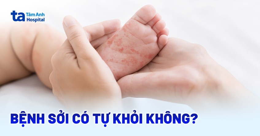 bệnh sởi có tự khỏi không