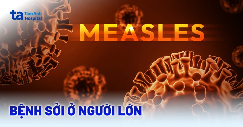 Bệnh sởi ở người lớn có nguy hiểm không? Dấu hiệu và cách trị