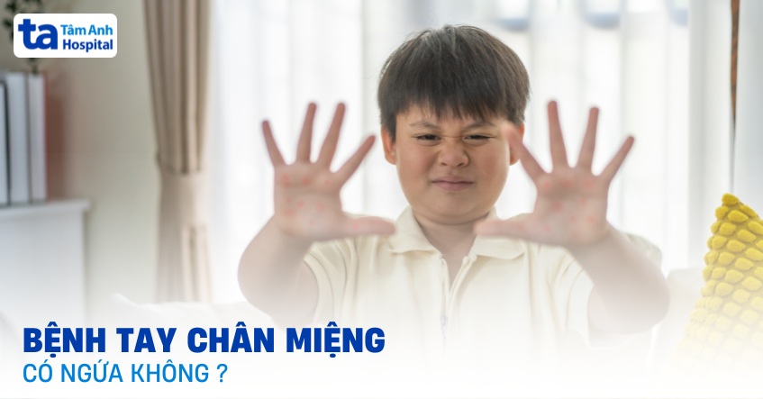 Bệnh tay chân miệng có ngứa không? Các cách giảm ngứa hiệu quả