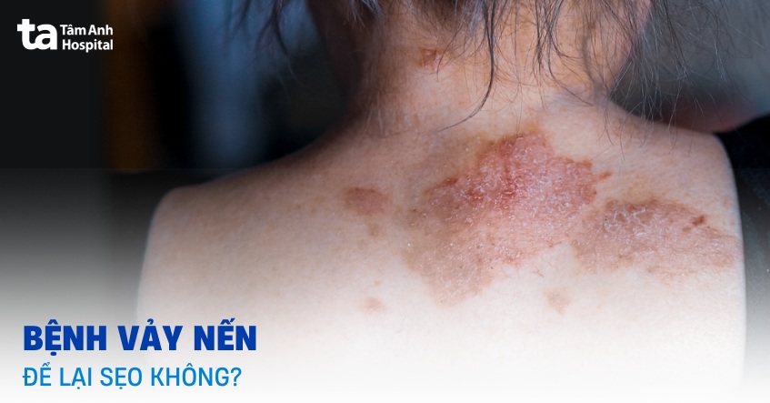 Bệnh vảy nến có để lại sẹo không? Lưu ý để hạn chế