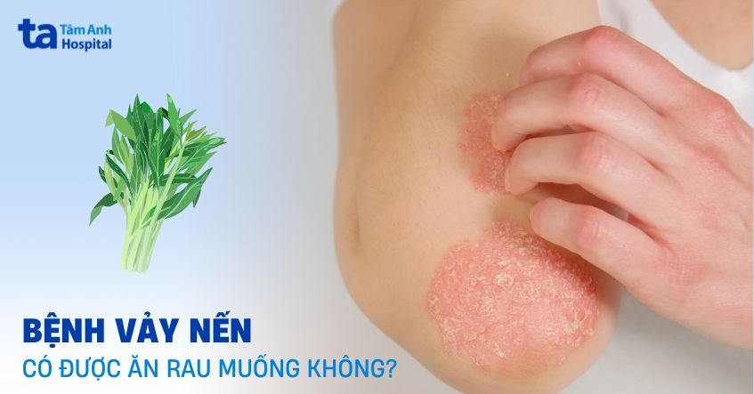 Bệnh vảy nến có được ăn rau muống không? Bác sĩ giải đáp