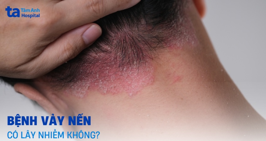 Bệnh vảy nến có lây không? Yếu tố nào tăng nguyên nhân mắc bệnh?
