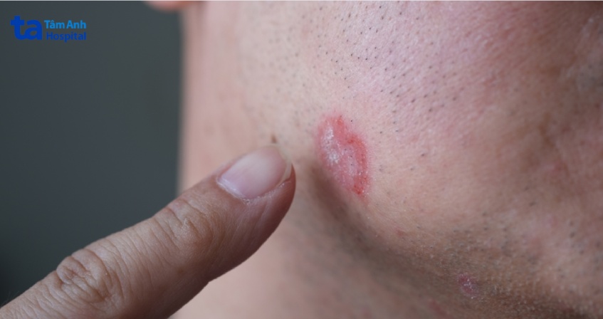 bệnh vảy nến xuất hiện trên khuôn mặt