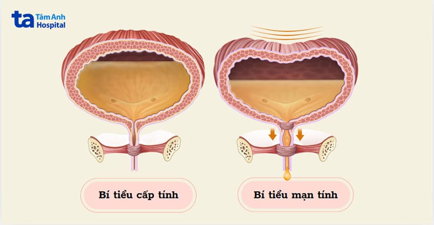bí tiểu cấp tính và mãn tính có thể xảy ra ở người già