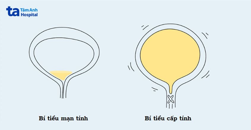 bí tiểu là tình trạng người bệnh không thể đi tiểu bình thường