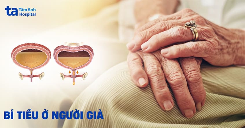 Bí tiểu ở người già nguy hiểm như thế nào? Cách điều trị ra sao?