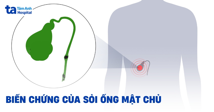 8 biến chứng của sỏi ống mật chủ và dấu hiệu nhận biết
