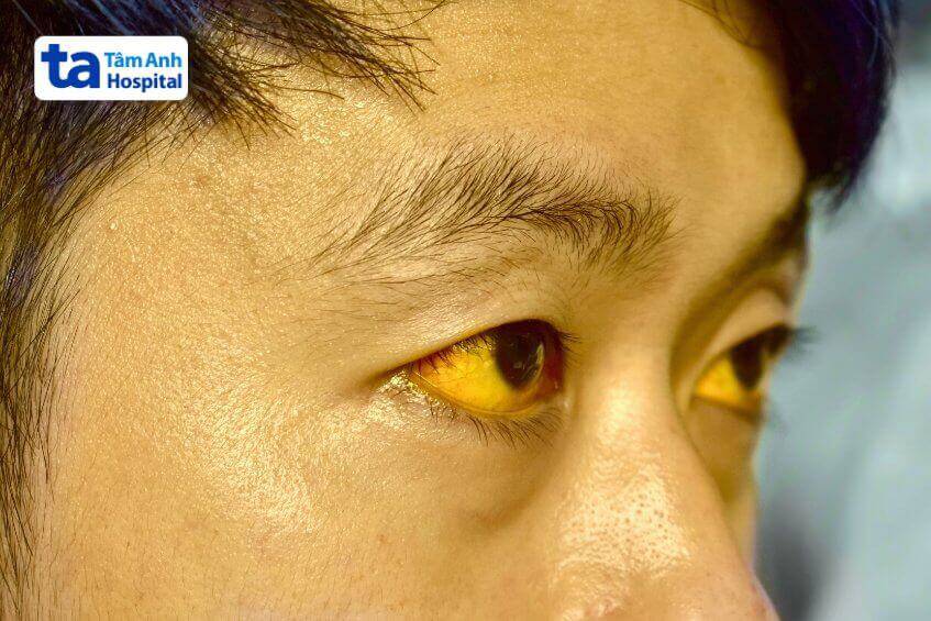 biến chứng sỏi đường mật trong gan