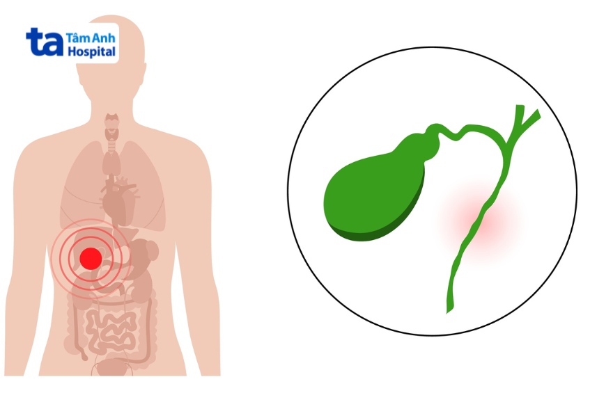 biến chứng sỏi ống mật chủ