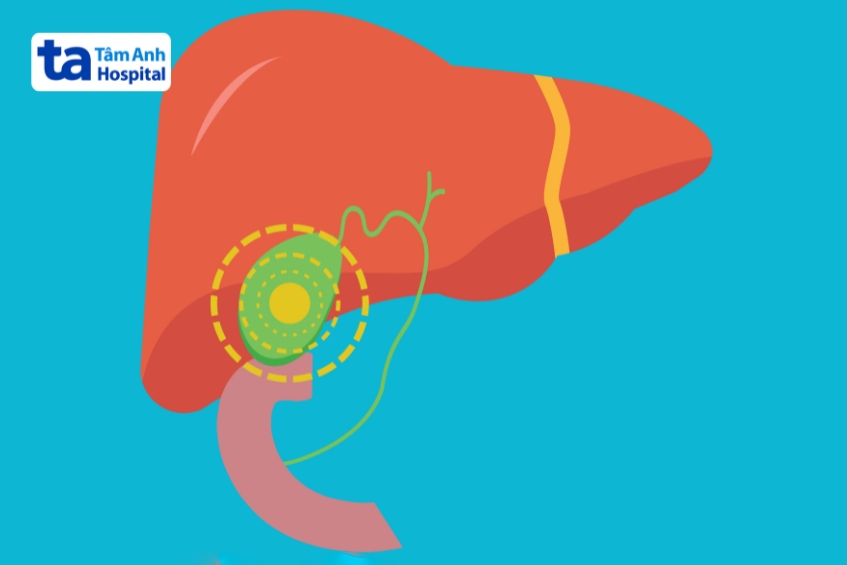 biến chứng viêm gan A