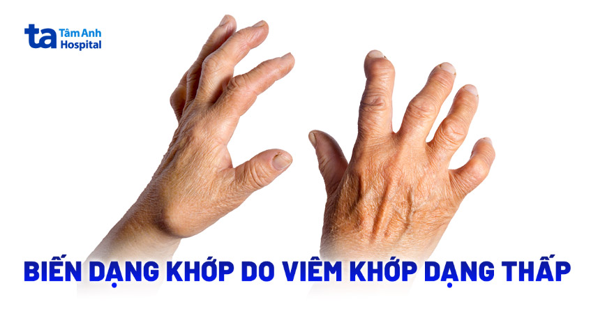 Các kiểu biến dạng khớp do viêm khớp dạng thấp gây ra