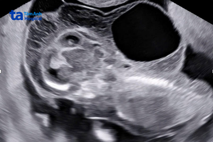 biểu hiện da gáy dày