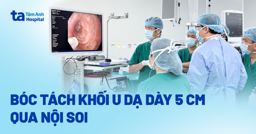 bóc tách khối u dạ dày qua nội soi