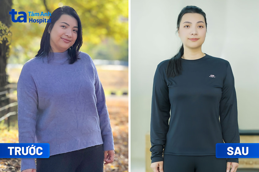 Chị Trần Phan Cẩm Hà trước và sau giảm cân tại BVĐK Tâm Anh