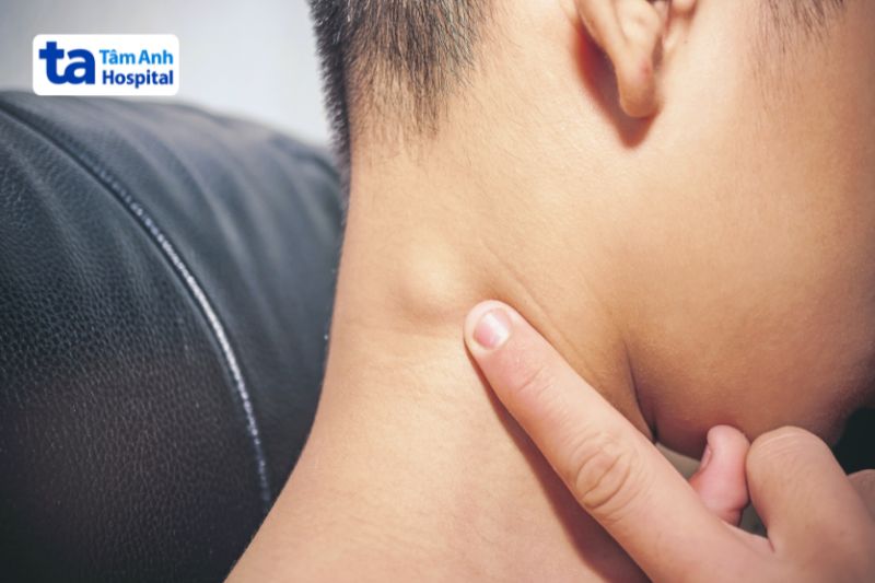 Hạch bạch huyết sưng