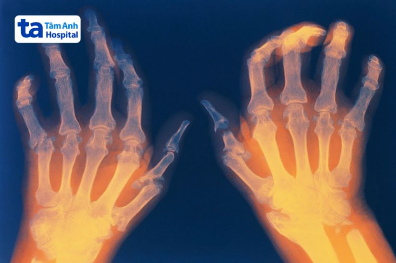ảnh X-quang của bàn tay bị viêm khớp dạng thấp