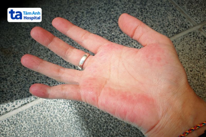 Lupus ban đỏ hệ thống (SLE)