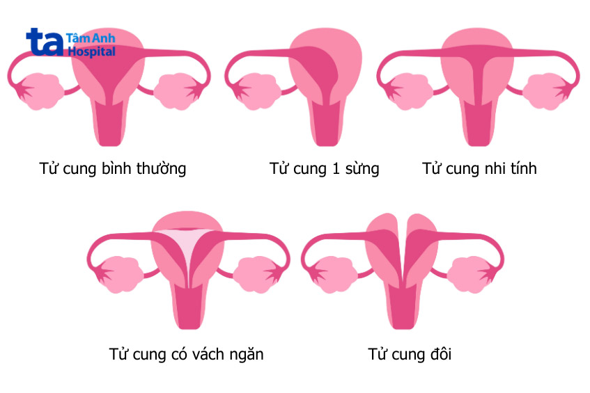 các dị tật bẩm sinh ở tử cung