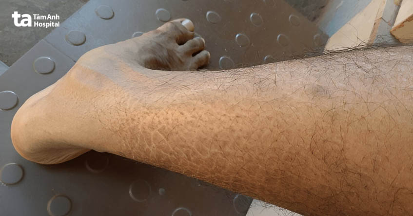 Các tế bào chết của người mắc bệnh vảy cá