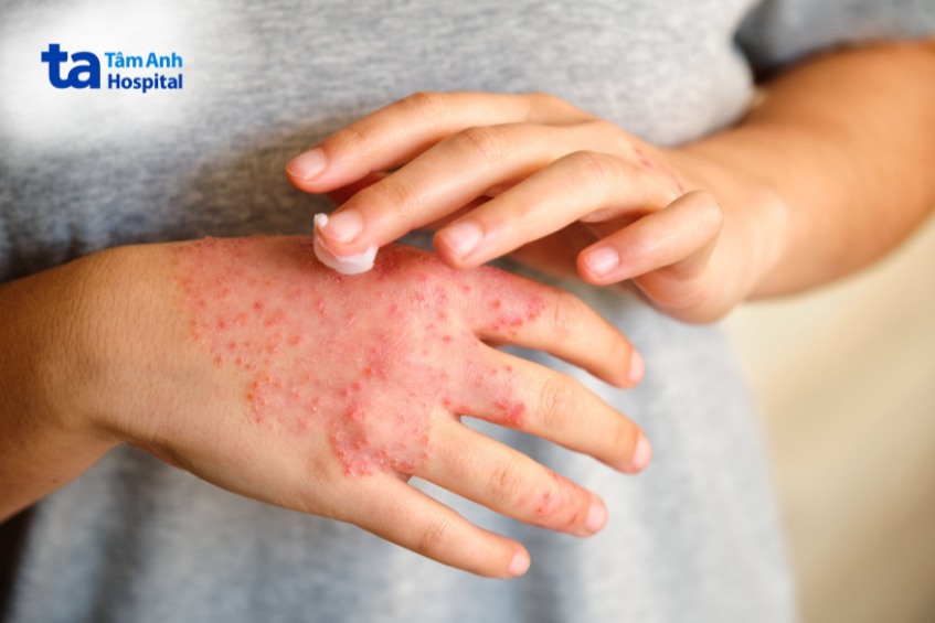 cách điều trị viêm da cơ địa ở người lớn