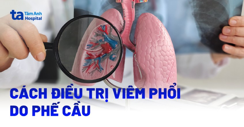 3 cách điều trị viêm phổi do phế cầu an toàn và hiệu quả cao