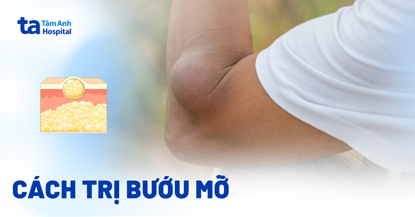 3 cách trị bướu mỡ hiệu quả và những lưu ý cần biết
