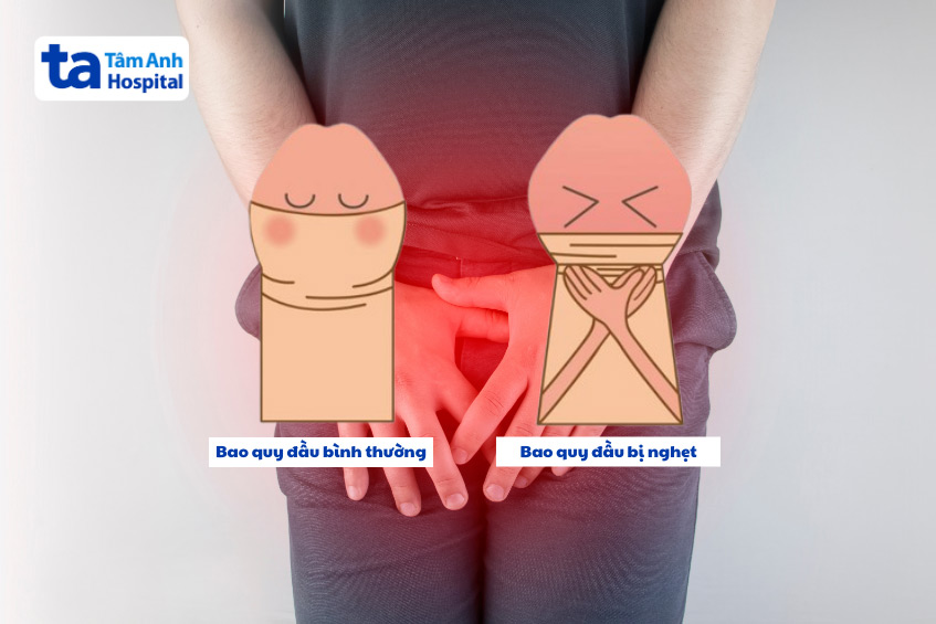 Cần nhận biết các dấu hiệu thắt nghẹt bao quy đầu để cấp cứu kịp thời